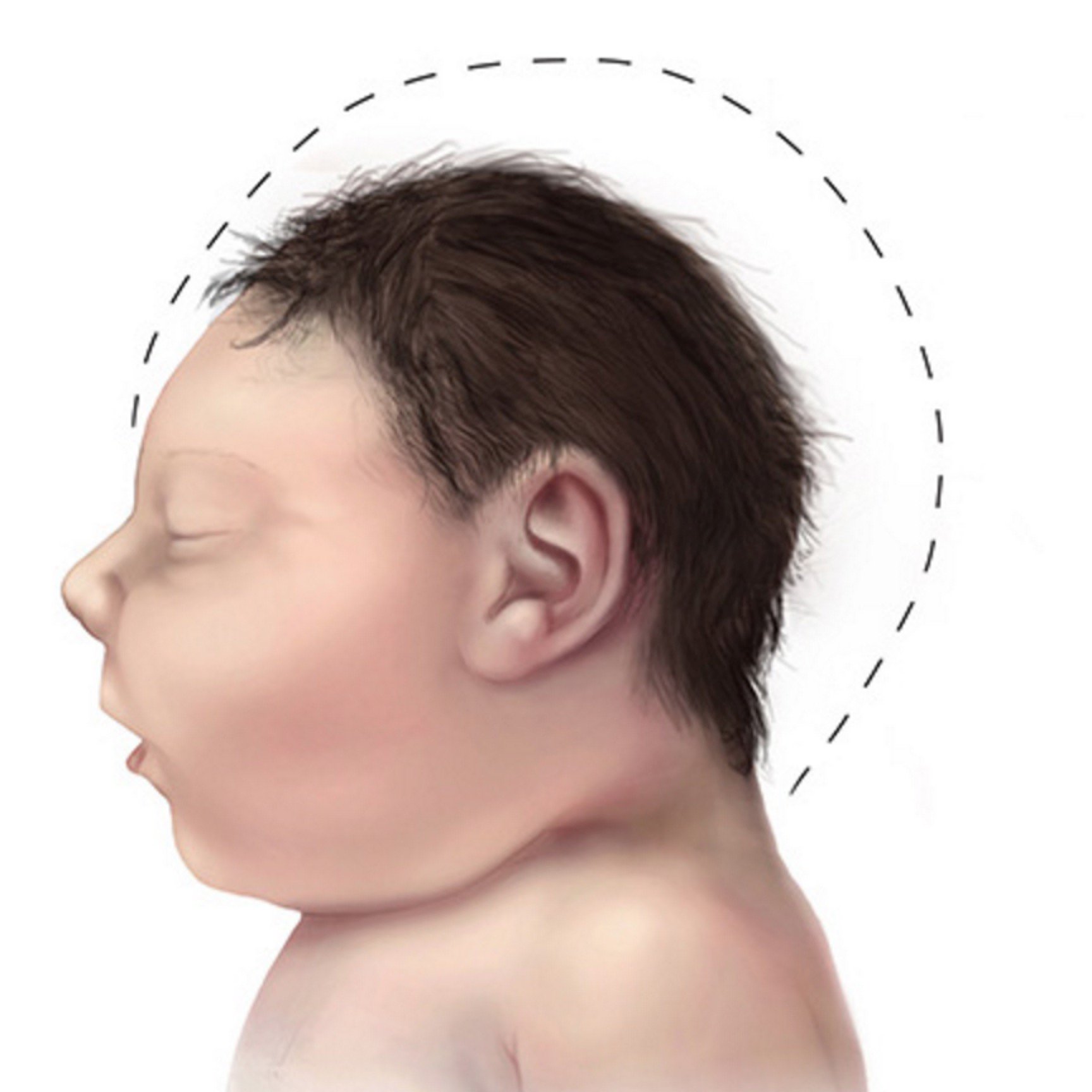 新生儿,颌骨,颌骨发育不全,大小脸,医疗图片素材_高清图片素材